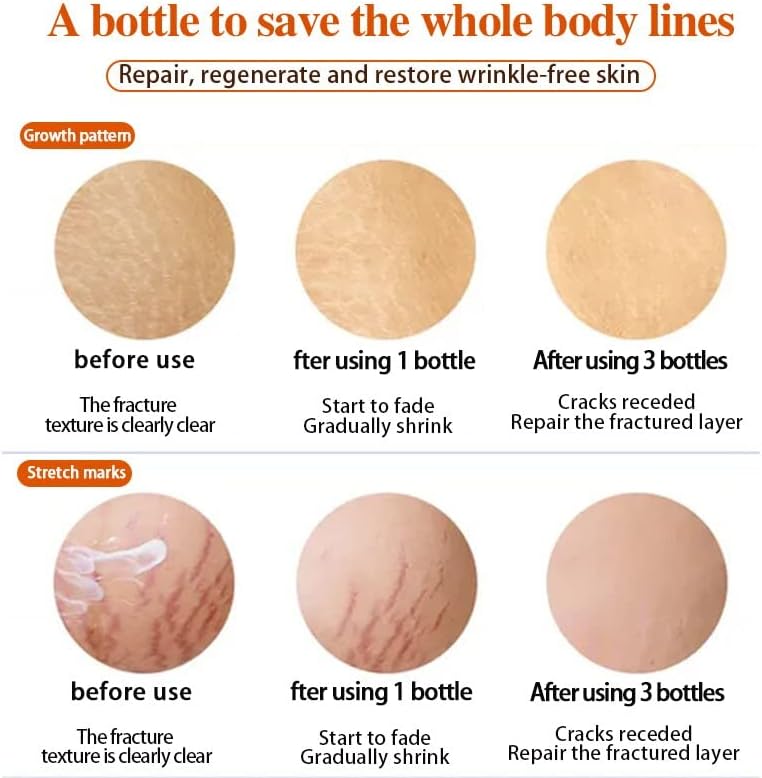 30G Remova as cicatrizes de gravidez acne Creme estrias de estrias de tratamento levantando o cuidado da pele de panorização da