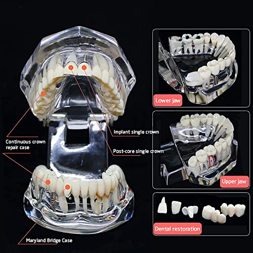 Modelo de dentes de doença transparente, youya dental transparente dentes de implante dental modelo dentista doenças padrão doenças removíveis de ensino patológico