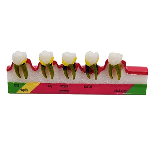 Modelo de dentes dentários Modelo de classificação periodontal de doenças Excelente ensino e suprimentos inclinados （2 pacote)