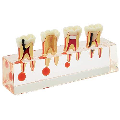 Modelo de tratamento endodôntico de 4 estágios DentalMall Dental para Estudo Ensinar dentes Modelo 4018 Raiz Demonstração de Anatomia de Ensino Modelo de dente