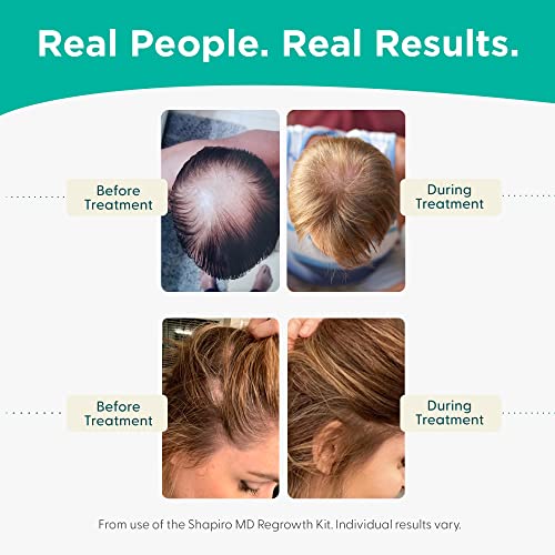 Shampoo e condicionador de perda de cabelo | DHT Formula vegana de combate a um cabelo de afinação desenvolvido por dermatologistas | Experimente cabelos mais saudáveis, mais cheios e mais grossos - Shapiro MD | Fornecimento de 4 meses